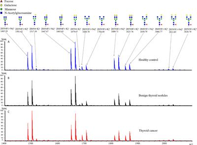 Diagnostic Potential of Plasma IgG N-glycans in Discriminating Thyroid Cancer from Benign Thyroid Nodules and Healthy Controls